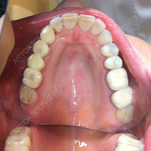 Выпадают передние зубы лечение